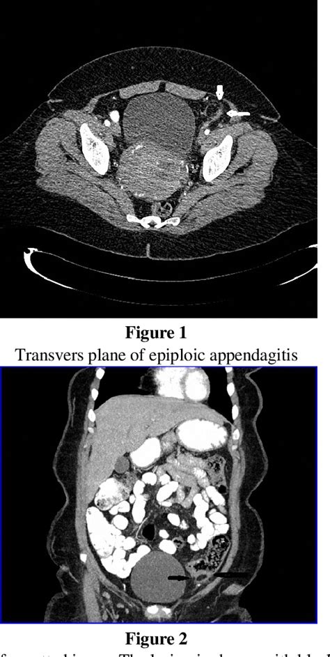 Figure 1 From A Rare Cause Of Abdominal Pain Primary Epiploic