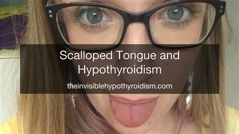Scalloped Tongue And Hypothyroidism Thyroid Disease Tongue Health