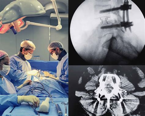 Cirurgia Minimamente Invasiva Da Coluna Dr Antonio Prates
