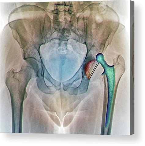 Dislocated Hip Replacement X Ray Acrylic Print By Zephyr