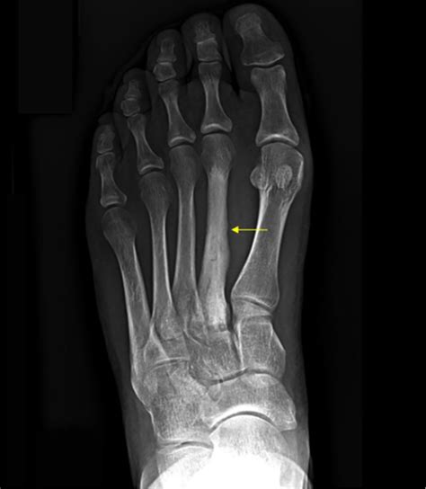 What Is A Hairline Fracture Podiatry First