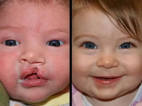 Cleft Palate Plastic Surgery Before After