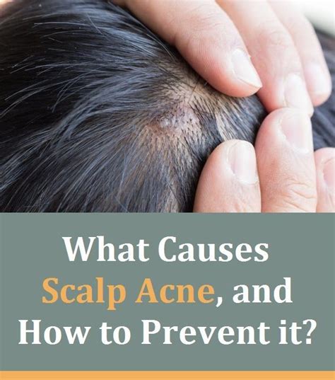 What Causes Scalp Acne And How To Prevent It Scalp Acne Acne