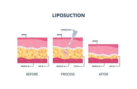 Liposuction Of Upper Back Get Rid Of The Back Fats Cosmeticium