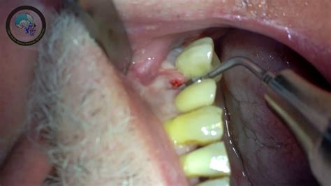 Atraumatic Piezotome Tooth Extraction And Implant Insertion Youtube