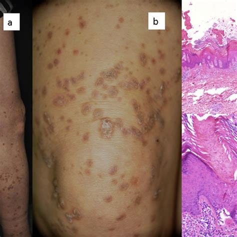 Clinical Appearance Annular Brown Hyperkeratotic 05 1 Cm In