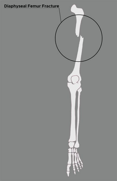 Figure Illustration Of Femur With Diaphyseal Fracture Statpearls