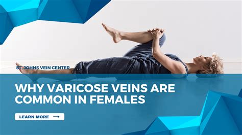 Why Varicose Veins Are Common In Females St Johns Vein Center