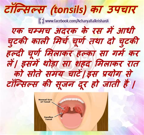 How To Prevent Tonsil Stones Naturally How To Do Thing