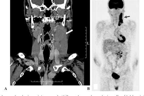 Figure 1 From Epstein Barr Virus Associated Lymphoproliferative