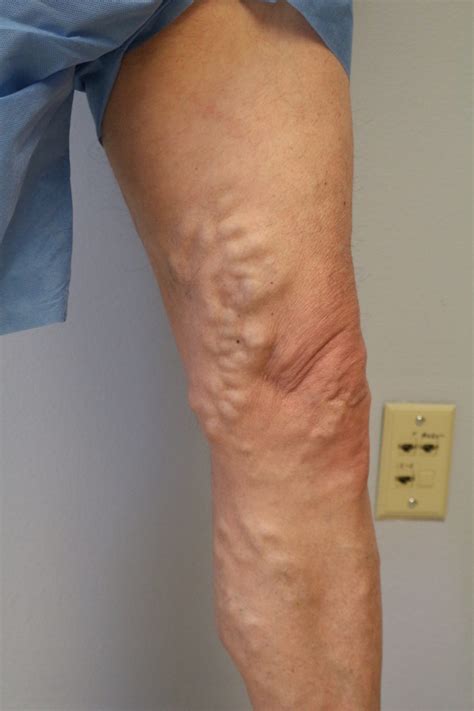 Varicose Veins Before And After Pictures Images Surgery Treatment