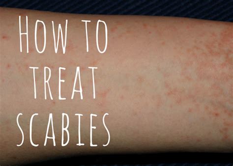 How Do You Know If Your Scabies Treatment Worked Healdove