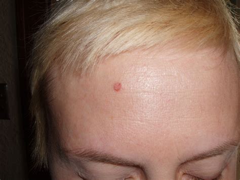 Raised Patch Of Skin On Forehead