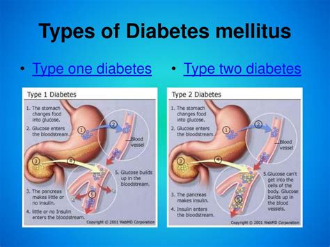 Diabetes Mellitus Types