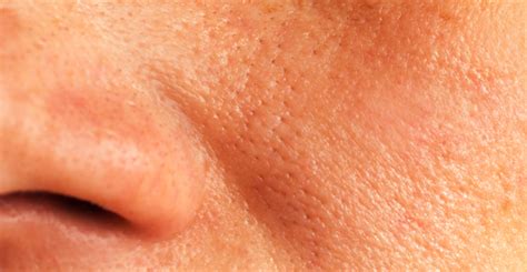 Helping To Shrink Enlarged Pores Beauty Health Times