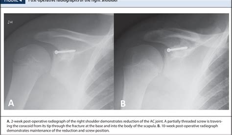 Figure 4 From Acromioclavicular ‘pseudo Dislocation With Concomitant