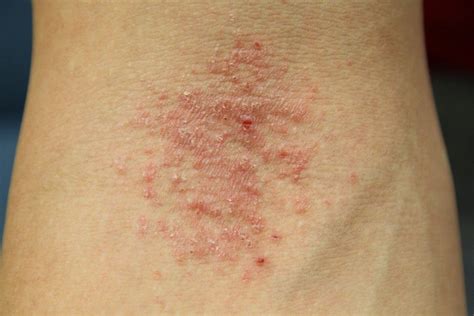 Thinking Moms Guide To Red Flags Eczema Types Of Skin Rashes