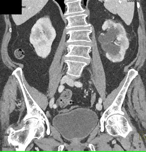 Transitional Cell Carcinoma Left Ureter Kidney Case Studies Ctisus