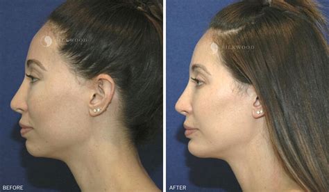 Chin Implant Surgery Sydney Before And After Gallery Dr Warwick Nettle