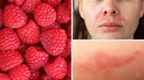 Doctors Explain What Happens To Your Body After A Sunburn