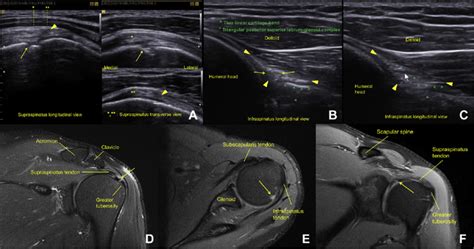 Supraspinatus Ultrasound View A Of A Cortical Impingement Cyst My Xxx