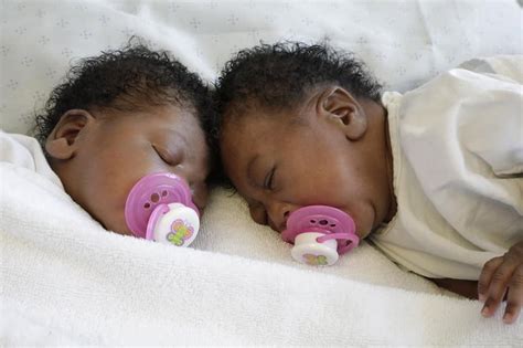 Feel Good News Conjoined Twins Successfully Separated