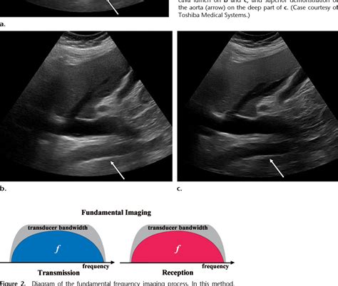 Clinical Use Of Ultrasound Tissue Harmonic Imaging The Meta Pictures