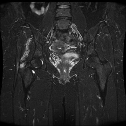 Calcific Tendinitis Of The Gluteus Medius Muscle Radiology Case