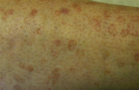 Red Spots On Arms