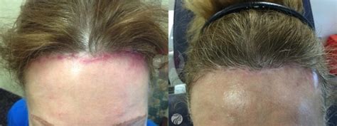 Pulsed Dye Laser Before And After Photo Gallery Dallas Plano And Frisco Tx Dallas Center