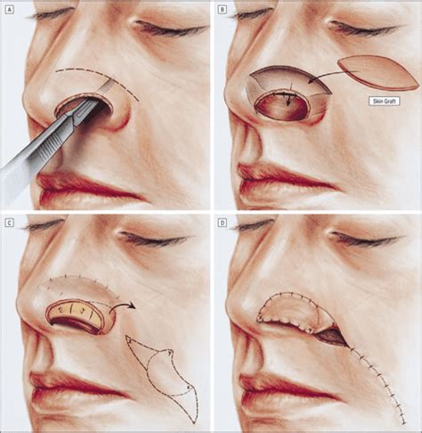 Figure 3 From Reconstruction Of Nasal Alar Defects Semantic Scholar