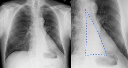 Have you ever taken a deep breath and felt a sudden sharp pain under the left rib? Lungs Behind Ribs / Ribs provide protection, but lung ...