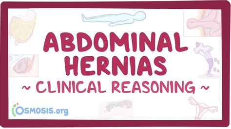 Hernias Clinical Video Anatomy Definition Osmosis