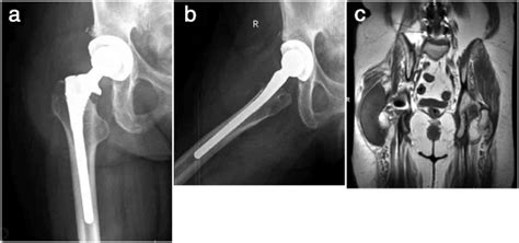 A Anteroposterior And B Lateral Radiographs Demonstrating An