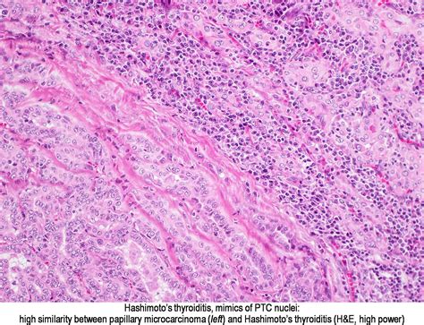 Pathology Outlines Hashimoto Thyroiditis