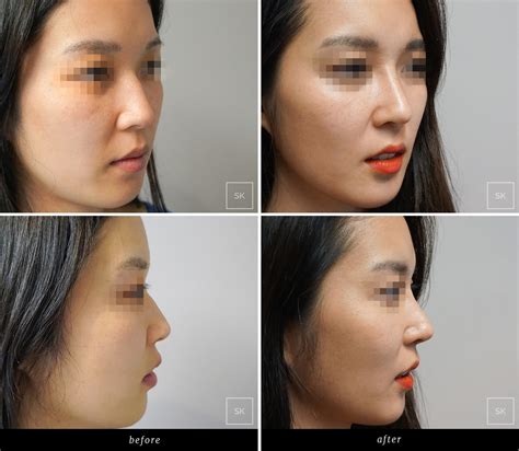 Nose Job Before And After Asian Women