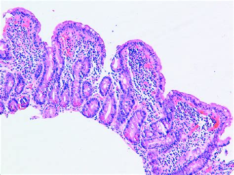 Microscopic Image Of The Duodenal Mucosal Biopsy He ×125 Reduced