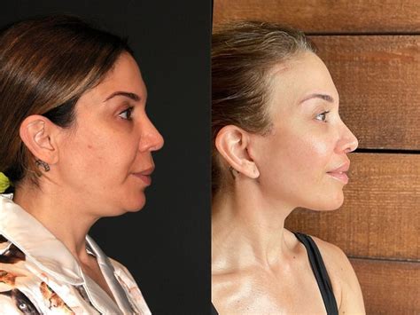 Deep Plane Facelift Before And After Dr Andrew Jacono Face Lift