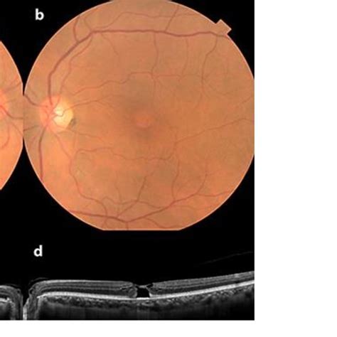 A Fundus Image Of The Right Eye B Fundus Image Of The Left Eye An
