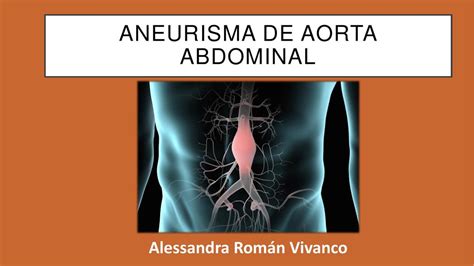 Aneurisma De Aorta Abdominal Alessandra Román Vivanco Udocz