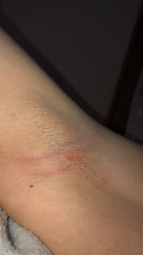 Rash Under Armpit And On Groin Dermatology Forums Patient