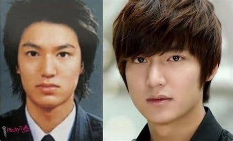 lee min ho plastic surgery before and after