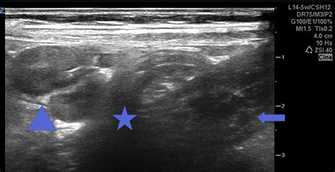 Identifying Retrocecal Appendicitis On Point Of Care Ultrasound Pocus