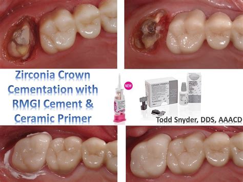 Decemented crowns often have thick layers of residual cement suggesting problems with either initial seating or cement 10. Zirconia Crown Cementation with FujiCEM2 and Ceramic ...