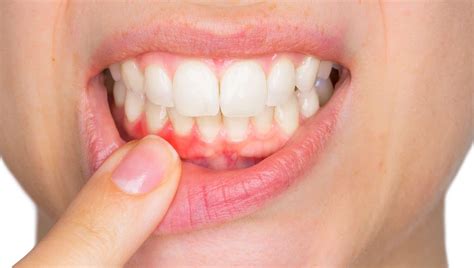 Pale Gums What Causes It Causes And Symptoms Muna Dental Clinic