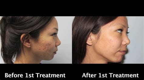 Asian Laser Acne Scar Removal With Before And After