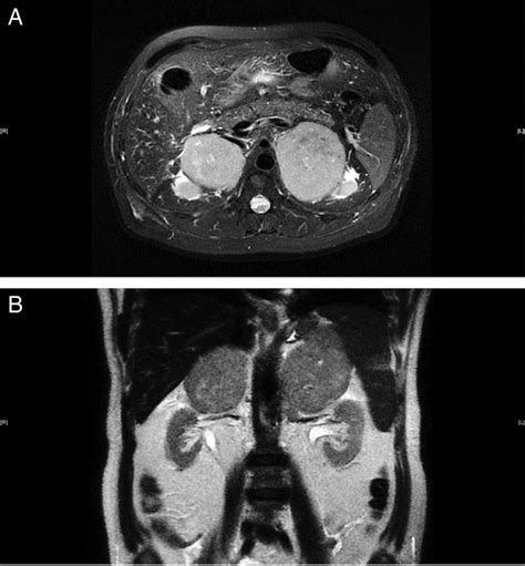 Bilateral Primary Adrenal Lymphoma With Adrenal Insufficiency Bmj