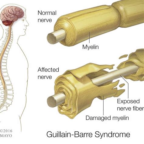 A Medical Illustration Of A Normal Nerve And A Damaged Nerve In The