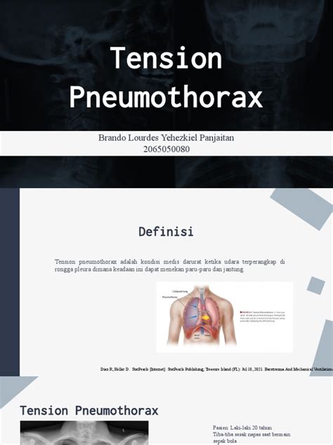 Tension Pneumothorax Pdf