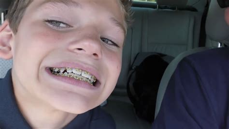We Are The Davises Watch Tyler Get Star Shaped Braces Youtube